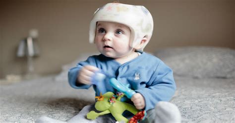 Parents Ignoring Sids Risk To Avoid Flat Head Syndrome