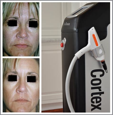 Laser Skin Resurfacing Charleston Charleston Facial Plastic Surgery