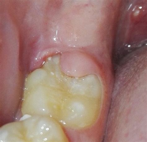 Lump Of Gum Growing Over Tooth Rdentistry