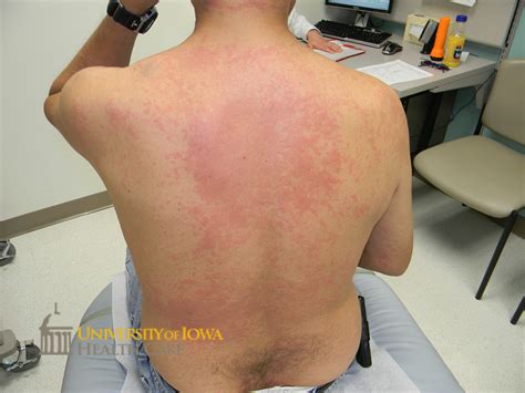 Brightly Erythematous Papules Coalescing Into Plaques On The Back
