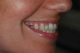 Photos of Teeth Bonding Insurance