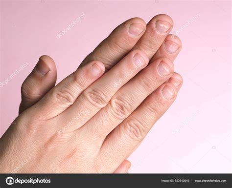 White Spots Nails Male Hand Caused Deficiency Calcium Zinc Poisoning