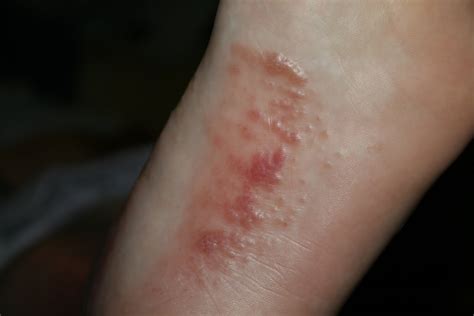 Rash On Arch Of Foot Pictures Photos