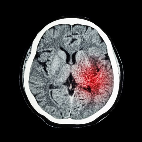 Ct Scan Of Brain Show Ischemic Stroke Or Hemorrhagic Stroke