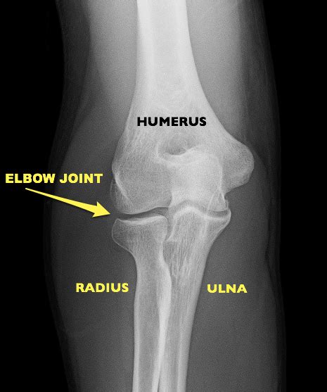 Elbow Fractures What Patients Should Know About Broken Elbows