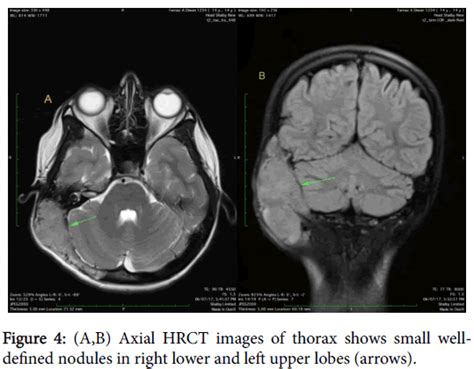 Radiology Left Upper Lobes