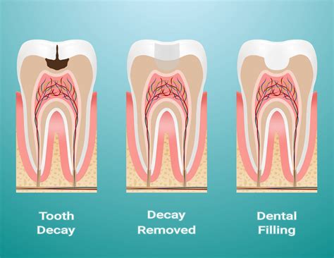 Restorations In Composite Orozen Dental Clinics