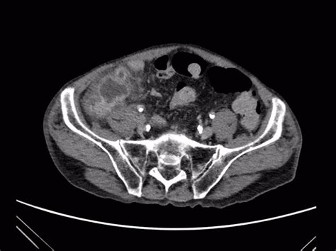Ct Scan Of Abdomen Demonstrating Peri Appendiceal Abscess With