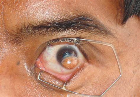 Limbal Dermoid Nejm