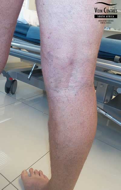 Dr Johan Blignaut Before And After Pictures