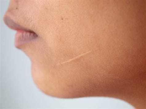 Scar Treatment That Works 17 Ways To Reduce And Prevent Unsightly Scars University Health News