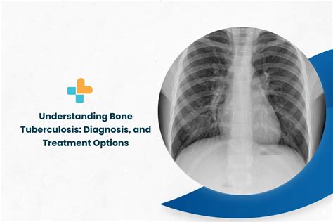 Understanding Bone Tuberculosis Diagnosis And Treatment Options