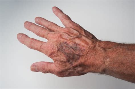 Bruises And Blood Spots Under The Skin That Occur On Older People Stock