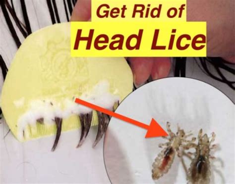How To Get Rid Of Lice Head Lice