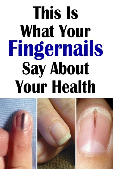 This Is What Your Fingernails Say About Your Health Fingernails