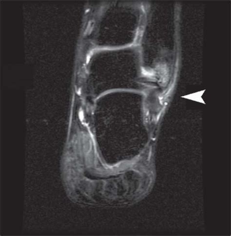 For diseases associated with the prostate, one would expect to find a chapmans point located anteriorly along the superior margin of the iliotibial band. The Foot and Ankle | Radiology Key