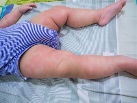 Sometimes it can be hours later, but that's very rare. 7 Signs Your Baby Has A Food Allergy & What To Do When ...