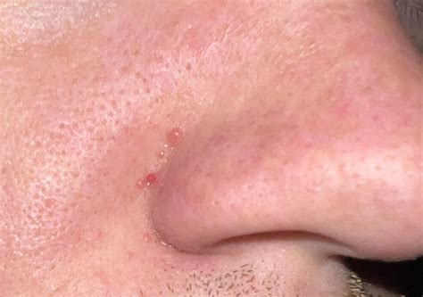 Could Anyone Tell Me What These Bumps Around My Nose Are Called Or Have