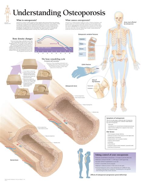 Osteoporosis Anatomy Poster Clinical Charts And Supplies