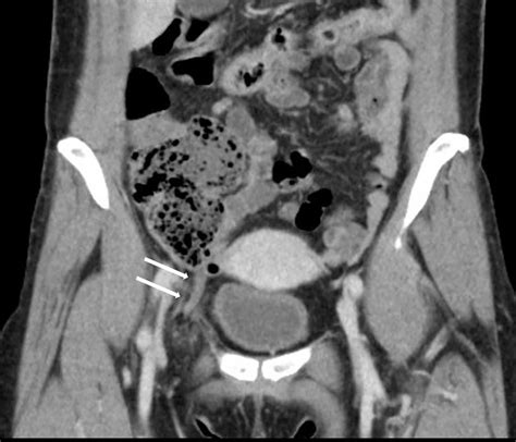 Coronal View In The Abdominal Ct Scan Shows The Appendix Inside The