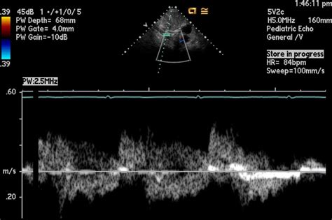 Pedi Cardiology Echo Descending Aorta Doppler Pattern Sp Repair Of