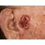 Squamous And Basal Cell Carcinoma Surgical Margins