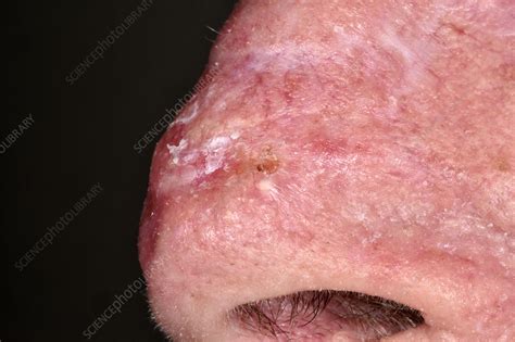 Skin Cancer On The Nose Stock Image C0511232 Science Photo Library