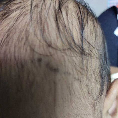 I Am Mother Of 3 Month Of Baby Girl Attached Herewith Is Scalp Of My