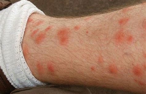 Itchy Raised Skin Bumps On Legs