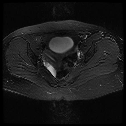 Unicornuate Uterus Radiology Reference Article Radiopaedia Org