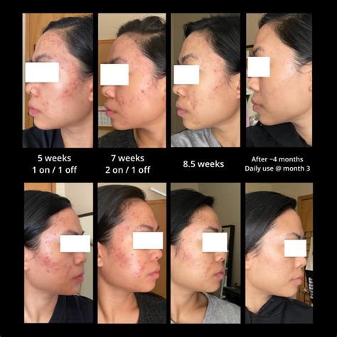 Tretinoin For Keloidhypertrophic Scars Tretinoin