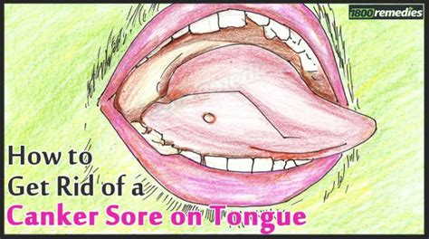 Tongue Canker Sore Causes And Treatments Canker Sore Canker Sore On