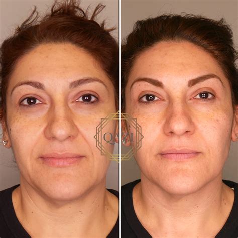 Marionette Line Treatment For Wrinkles And Sagging Jowls Qazi Clinic