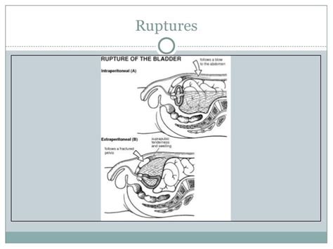 Urologic Traumapptx