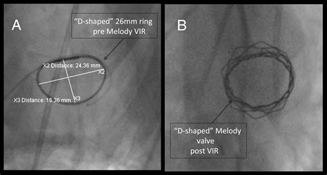 Percutaneous Transvenous Melody Valve In Ring Procedure For Mitral