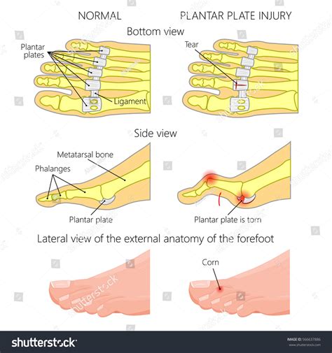 Vector Illustration Diagram Hammer Toe Plantar Stock Vector 566637886