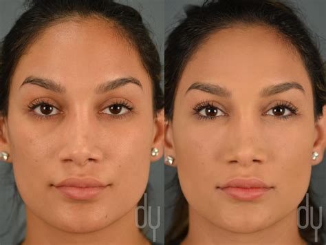 Before After Treatment Of Undereye Bags And Lower Eyelid Dark Circles