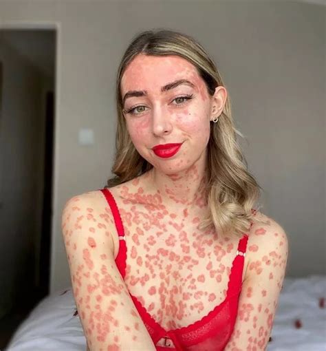Woman Covered In Psoriasis Refuses To Hide And Can Finally Look In The Mirror Daily Star