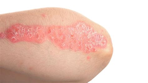7 Types Of Psoriasis And How To Tell The Difference Psoriasis Honey
