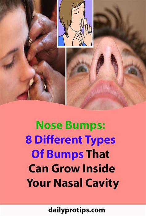 Nose Bumps 8 Different Types Of Bumps That Can Grow Inside Your Nasal