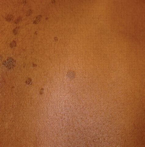 Diagnosis Of Pityriasis Versicolor In Paediatrics The Evoked Scale