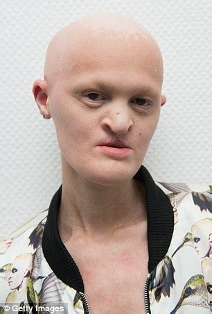 Welcome To Adamslink Media Meet Super Model With Rare Genetic Disorder Which Has Left Her Bald