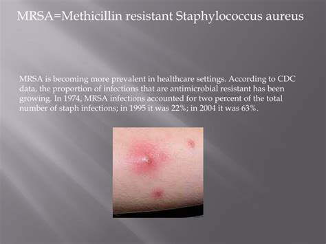 Ppt Mrsamethicillin Resistant Staphylococcus Aureus Powerpoint