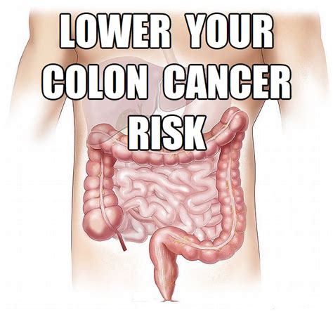 Preventive Steps To Lower Your Colon Cancer Risk