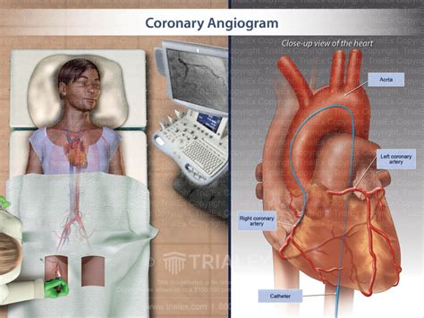 Coronary Angiogram Trialexhibits Inc