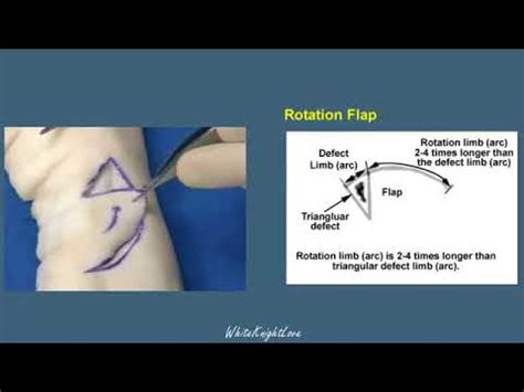 Rotation Flap Skin Flaps Essential Surgical Skills Whiteknightlove