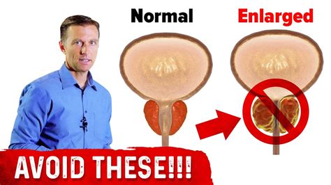 4 Things To Avoid If You Have An Enlarged Prostate Dr Berg Youtube