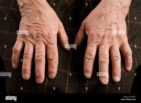 Arthritis Stockfotos Und Bilder Kaufen Alamy
