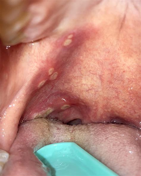 Canker Sores Or Something Else There Are Lots Of Them In My Throat