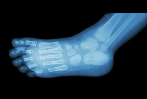 Case Report Diagnosis Of Pediatric Osteomyelitis With Reduced